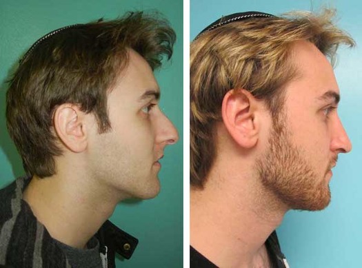 RNS-JEWS-NOSEJOB