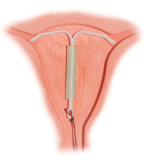 IntraUterine_System