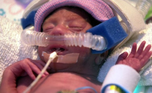 NNS PREMATURE BIRTHS.JPG