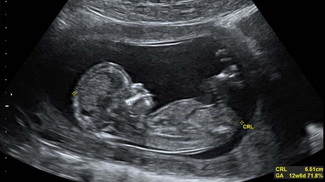 RNS-Fetus-Ultrasound1 081219